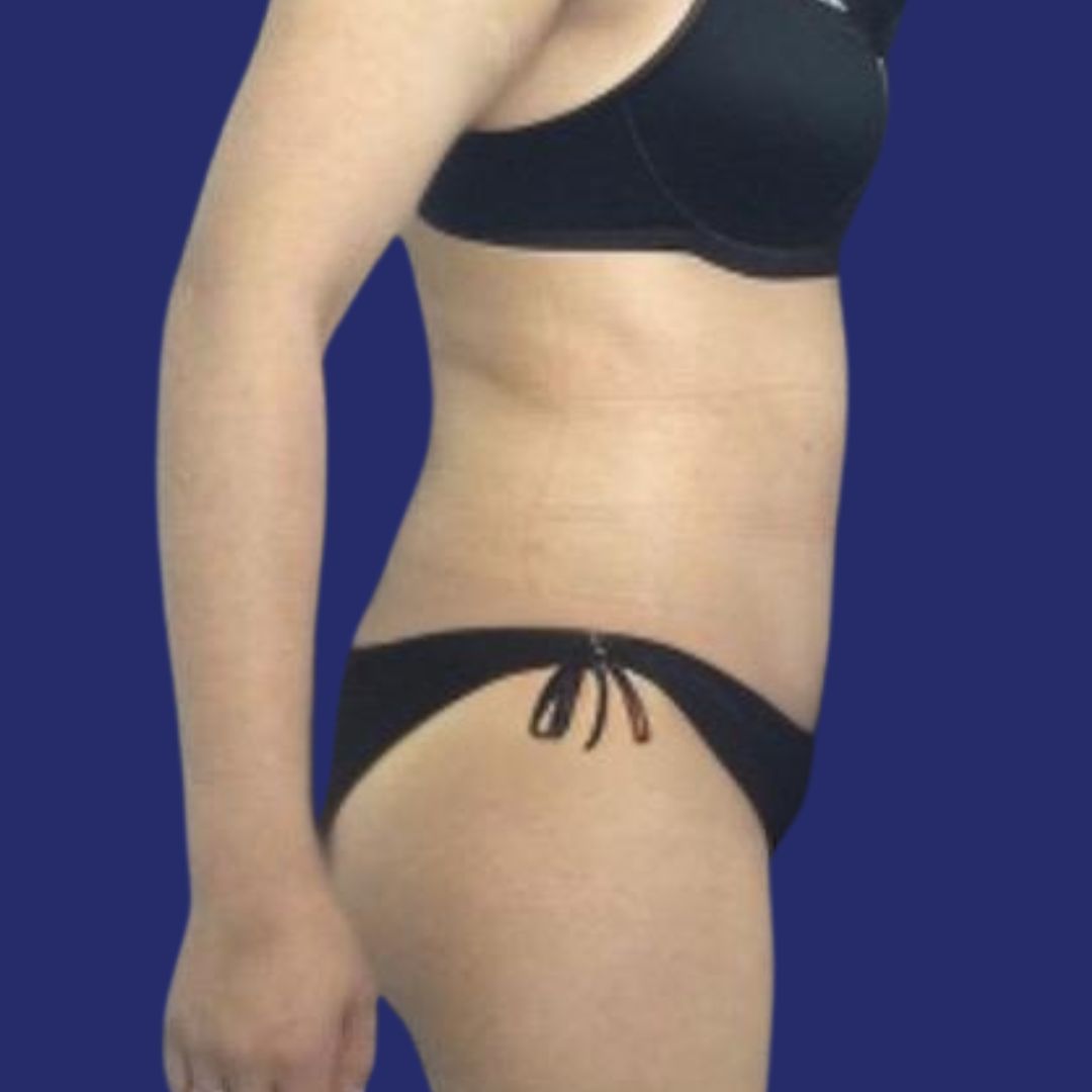 Flat abdominal skin after abdominoplasty