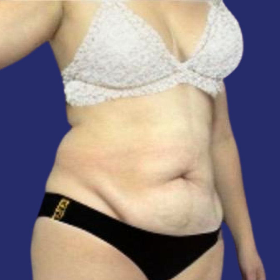 Patient corrective abdominoplasty for hanging skin  - Fleur-de-Lis Tummy Tuck