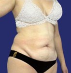 Patient mit korrigierender Abdominoplastik für hängende Haut - Fleur-de-Lis-Bauchdeckenstraffung