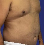 Abdominoplastik mit leichter Bauchmarkierung Männlicher