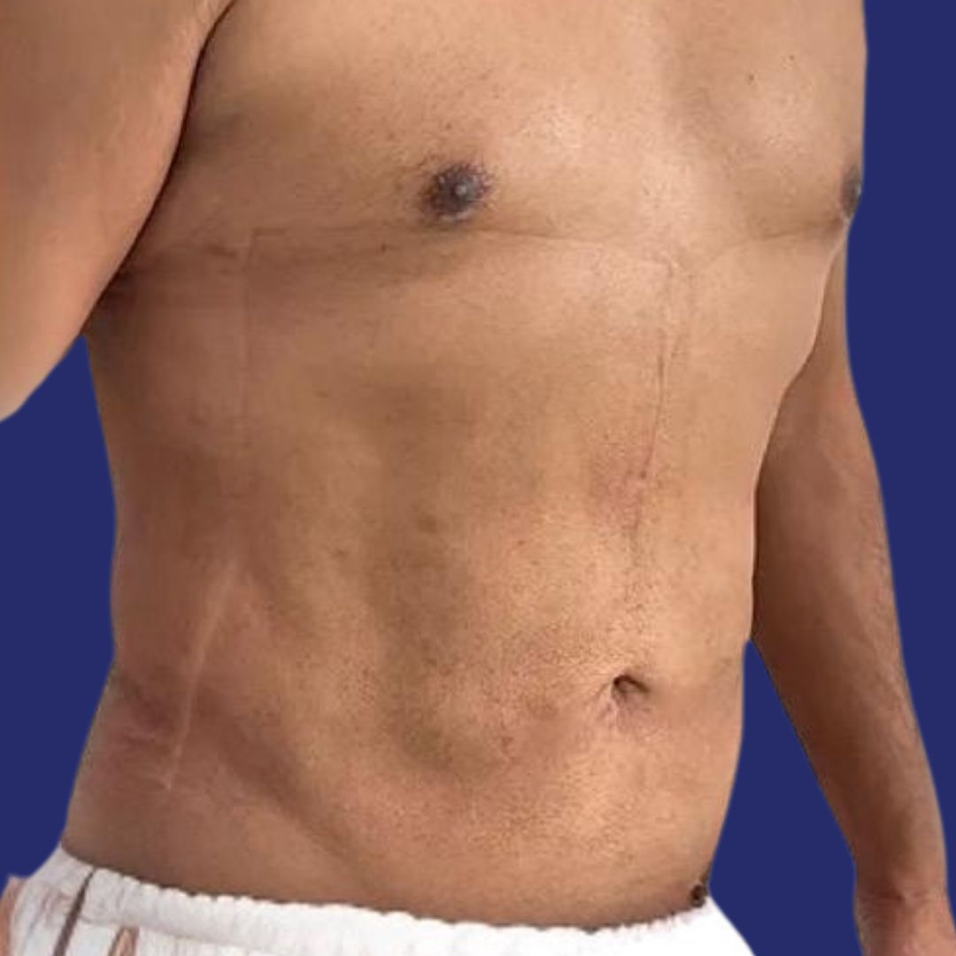 Male patient with restored abdominal muscles after abdominoplasty