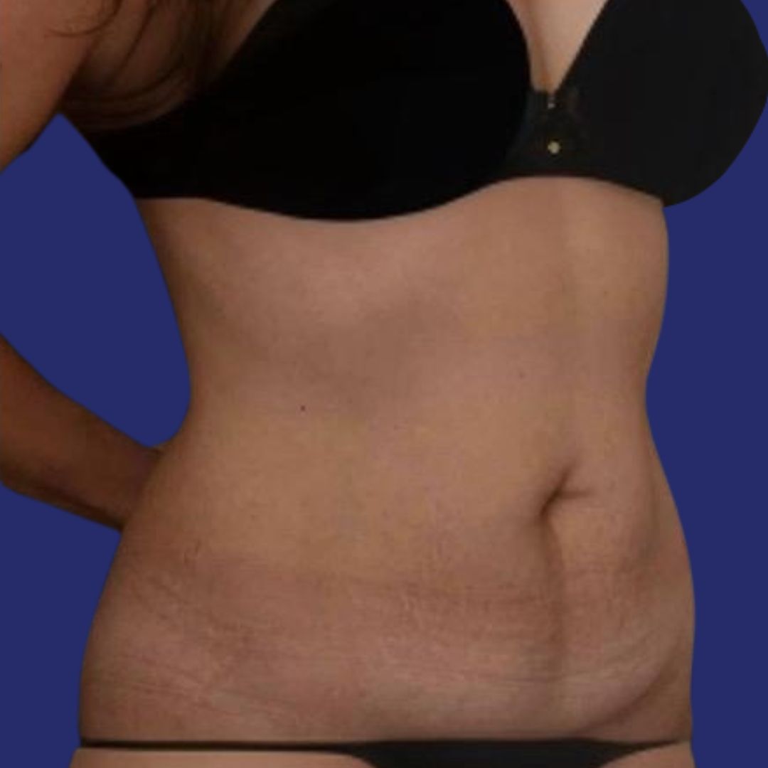 Patient abdomen before reconstructive abdominoplasty  