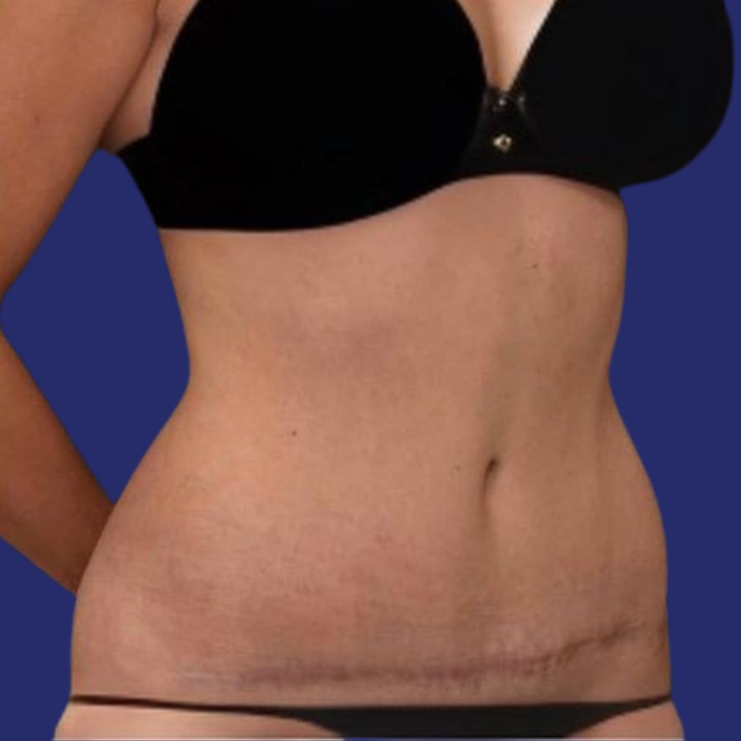 Patient with healed and reconstructed abdomen after abdominoplasty