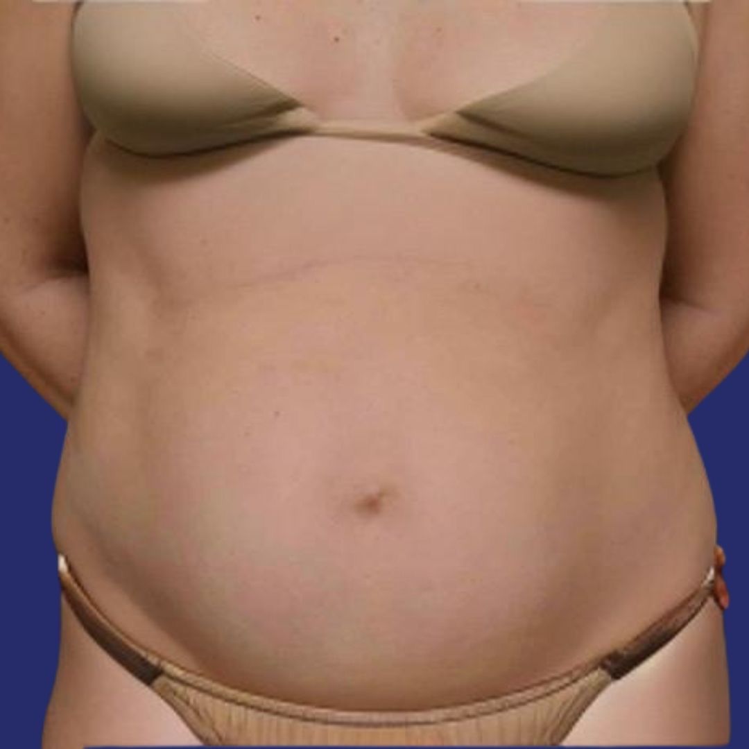 Patient with loose skin on the belly before plastic surgery tummy tuck