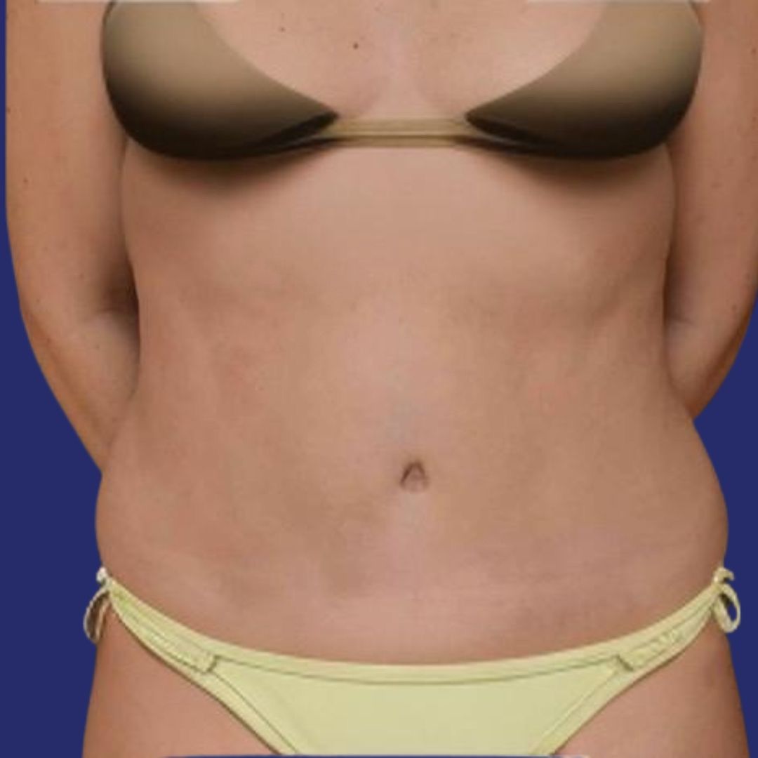 Patient with firm abdomen and no excess skin after plastic surgery tummy tuck