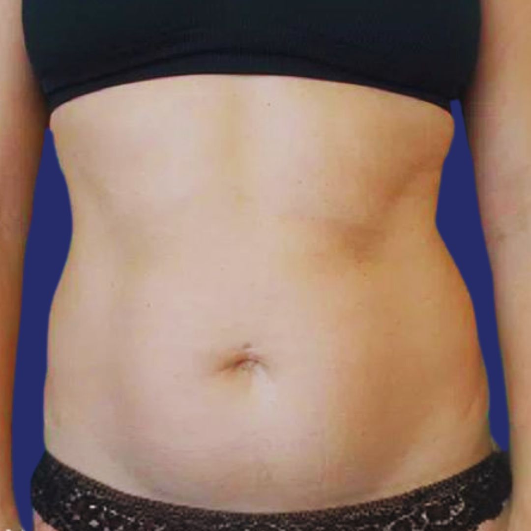 Candidate with slightly sagging abdomen before aesthetic mini abdominoplasty  