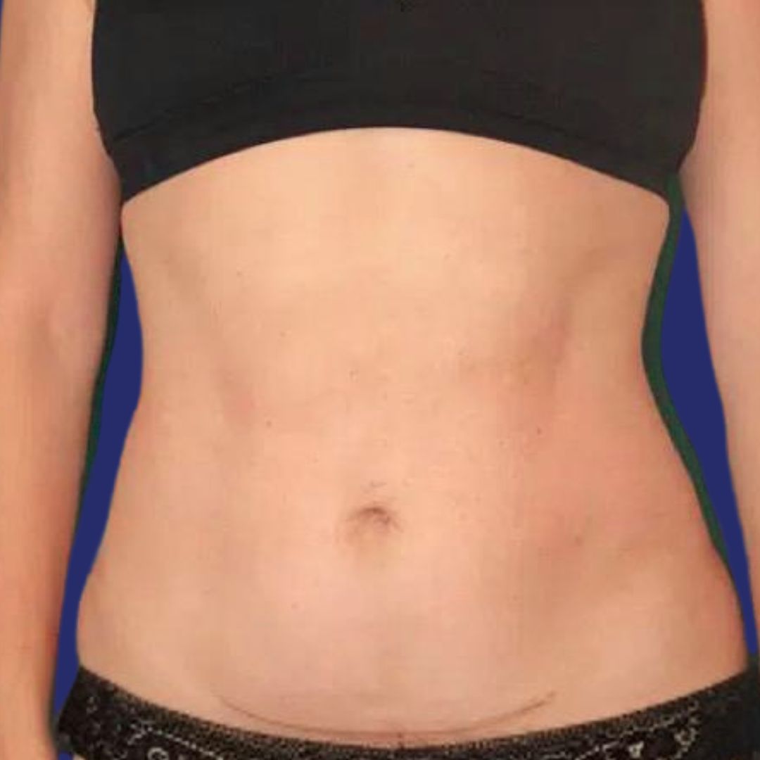 Candidate with aesthetically improved abdomen after mini abdominoplasty