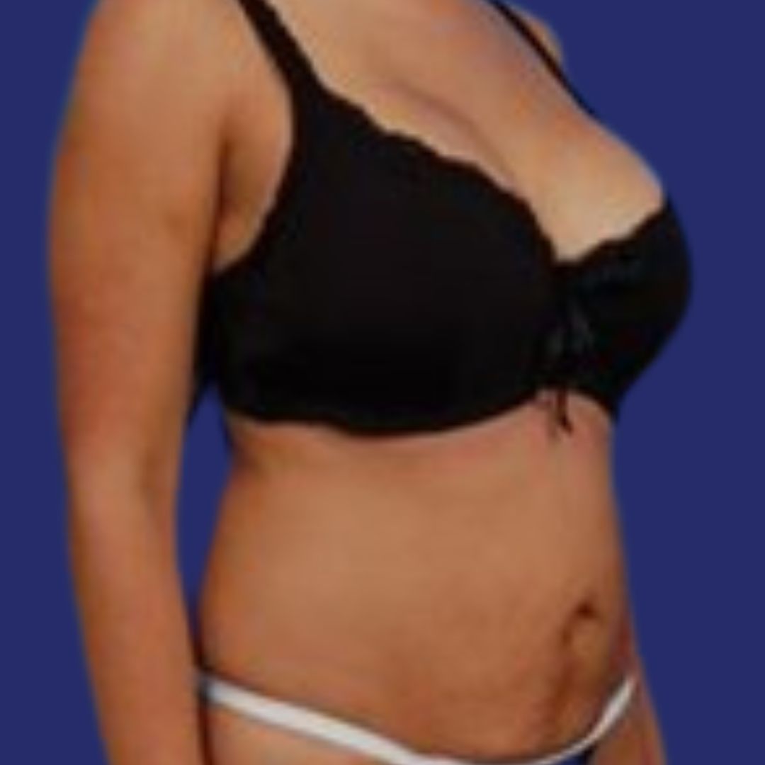 (Mini) tummy tuck photos