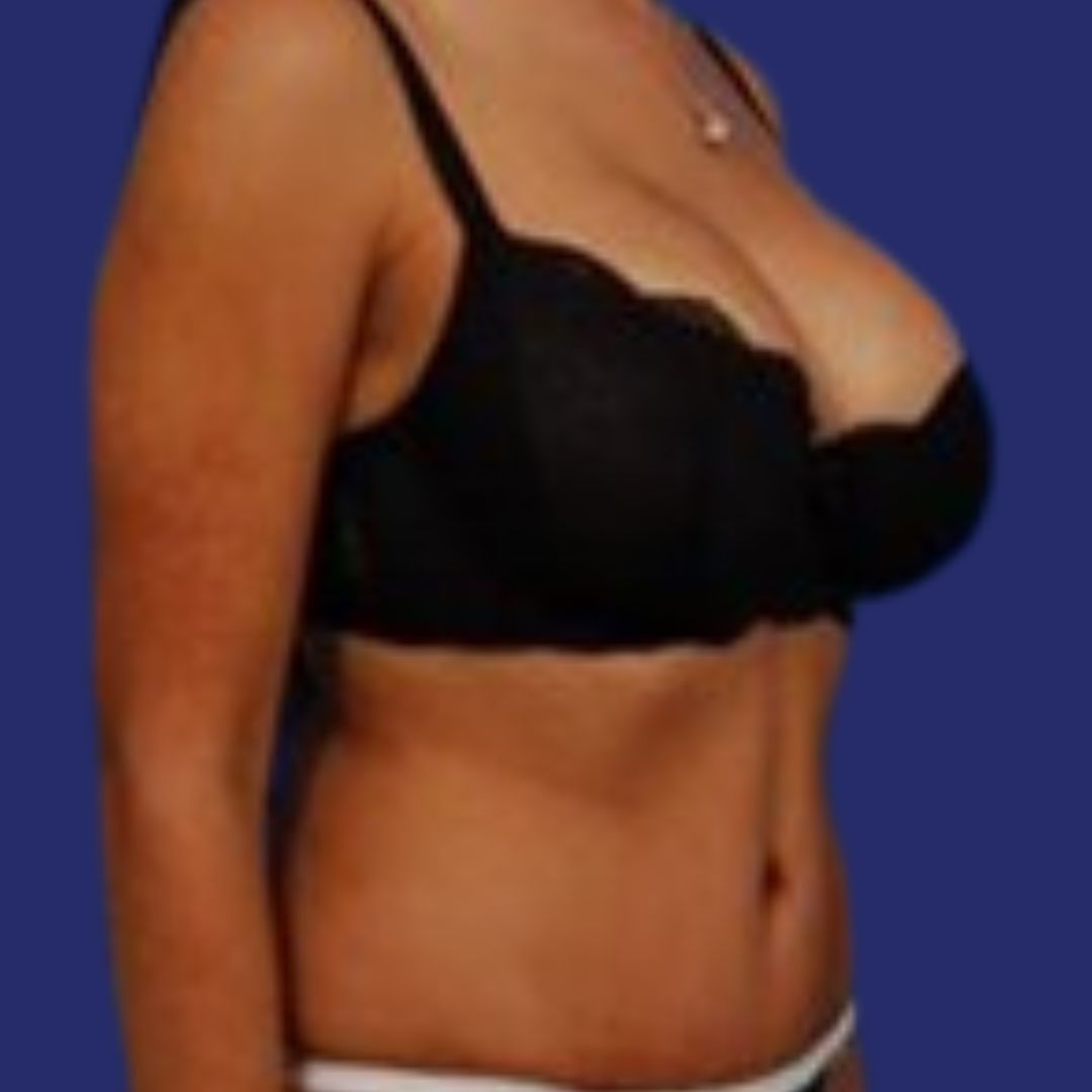  Mini tummy tuck before and after photos