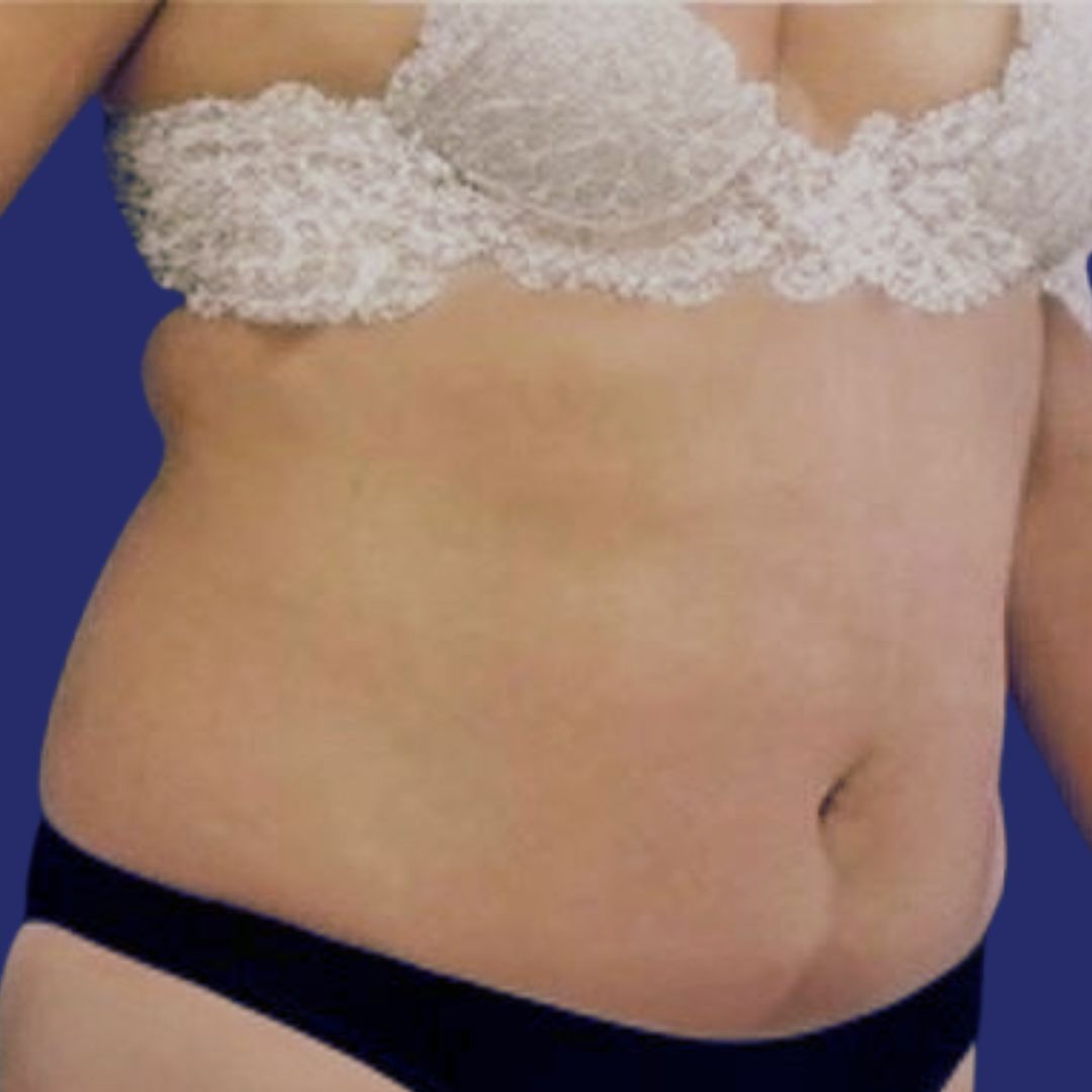 Total tummy tuck before and after photos 