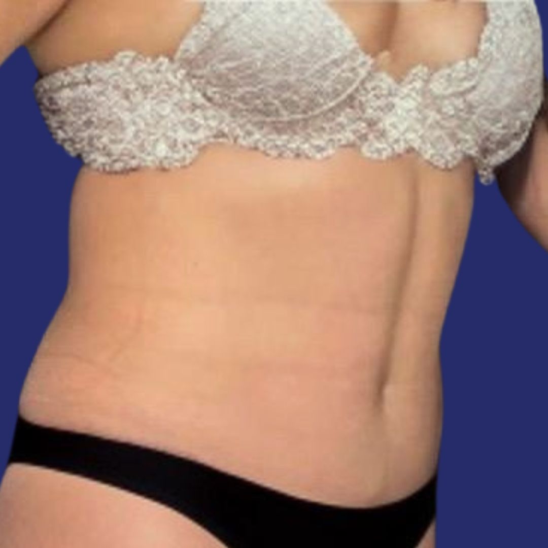 Patient with reduced and firm abdomen after abdominoplasty