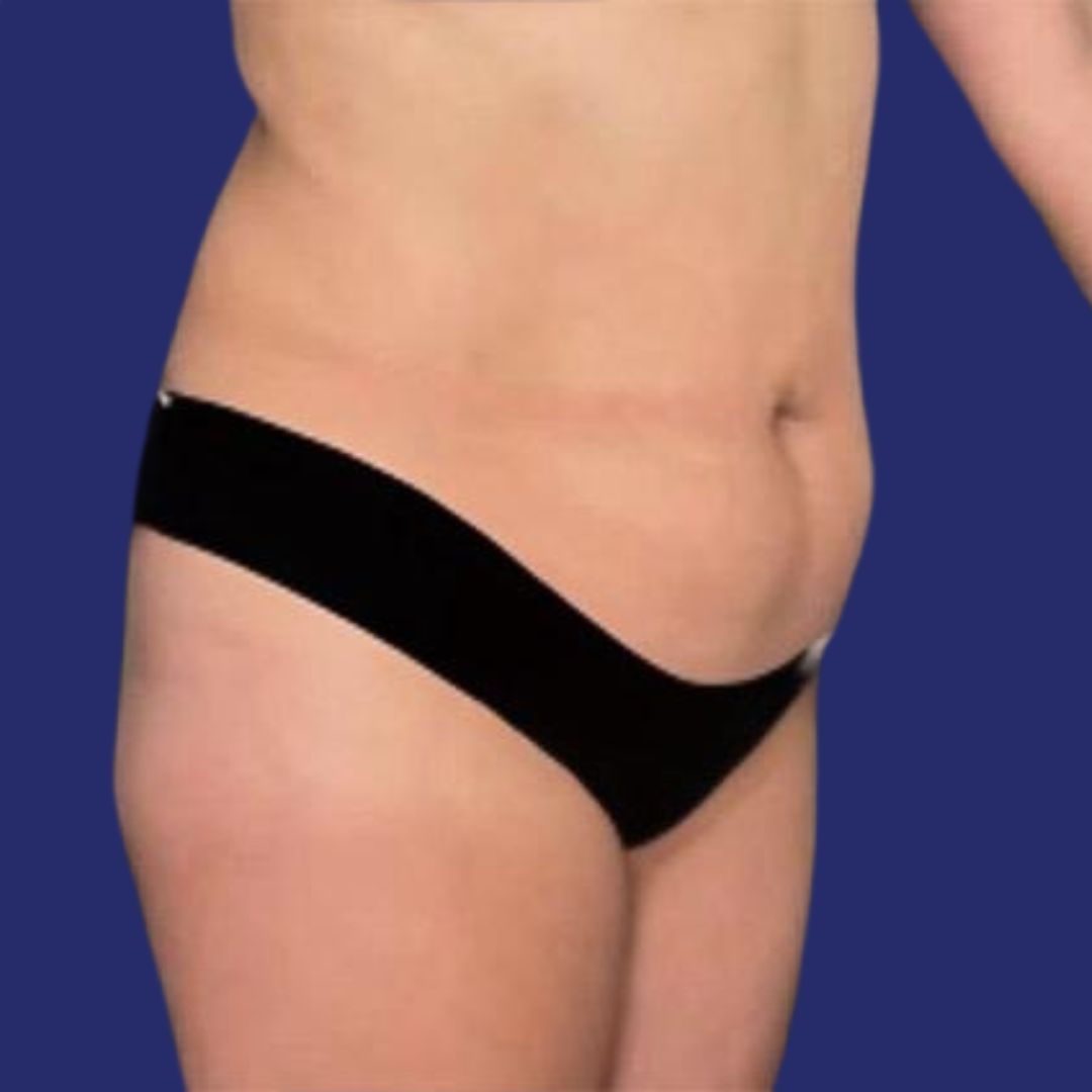 Abdomen before abdominoplasty after weight loss with hanging skin 