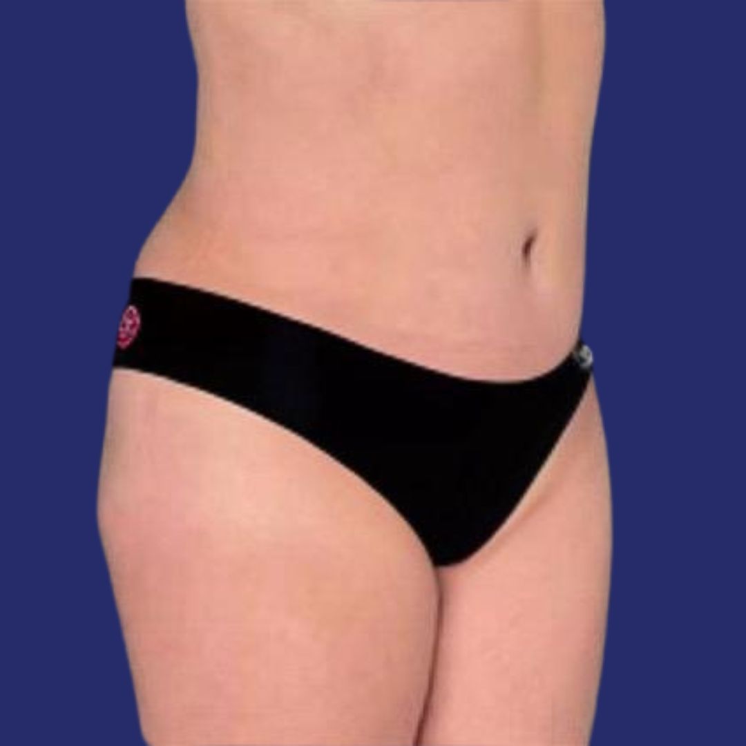 Aesthetic result of abdominoplasty to improve skin laxity