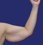Visible loose skin on upper arms before brachioplasty surgery