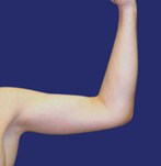 Smooth, tightened upper arm skin after brachioplasty.