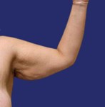 Patient with significant arm flabbiness prior to arm lift procedure.