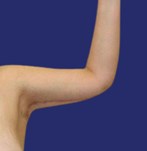 Defined upper arms with improved contour post-brachioplasty.
