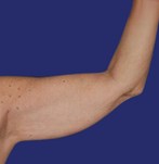 Side view of sagging arm skin before an arm lift surgery.