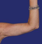 Side view showing firm and contoured arms after arm lift.