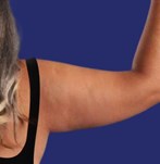 Patient with excess arm fat and skin before arm lift surgery.