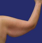 Arm with loose skin and reduced tone before brachioplasty