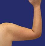 Arm showing smooth, tightened skin after lift surgery