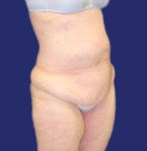 Pour lifting des cuisses combiné à une abdominoplastie : vue latérale montrant un relâchement au niveau des cuisses et un manque de contours corporels définis.
