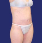Après le lifting des cuisses combiné à une abdominoplastie : vue latérale révélant une fermeté accrue et l’élimination de la peau lâche dans la région des cuisses.