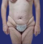 Image frontale avant lifting des cuisses et abdominoplastie, montrant une peau relâchée et un manque de fermeté à l’intérieur des cuisses.