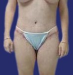 Après le lifting des cuisses et une abdominoplastie : image frontale montrant une amélioration de l’apparence des jambes, avec des cuisses plus fermes et mieux définies.