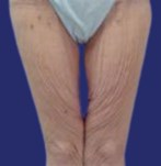 Pour lifting des cuisses : apparence des jambes avec un excès de peau et un relâchement au niveau supérieur des cuisses, conséquence d’une perte de poids.