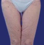 Résultats après le lifting des cuisses : peau lisse et élimination du relâchement dans la zone des cuisses.