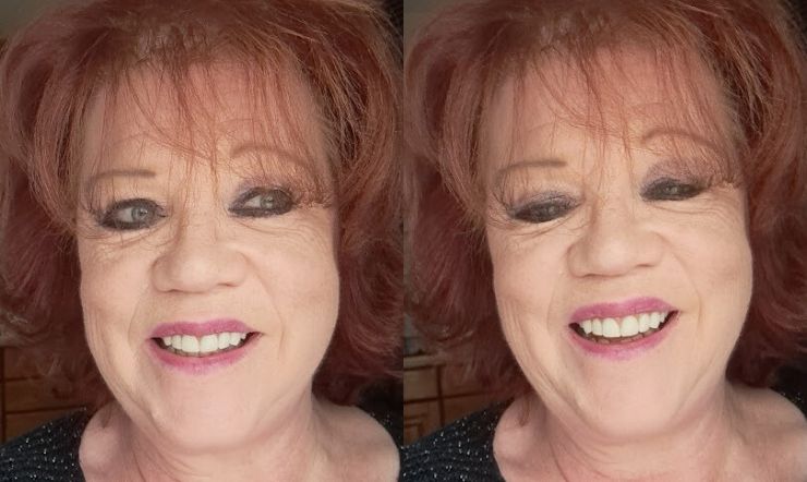 Mijn tandheelkundige traject bij Wellness Kliniek met Dr. Jan Van Dijck