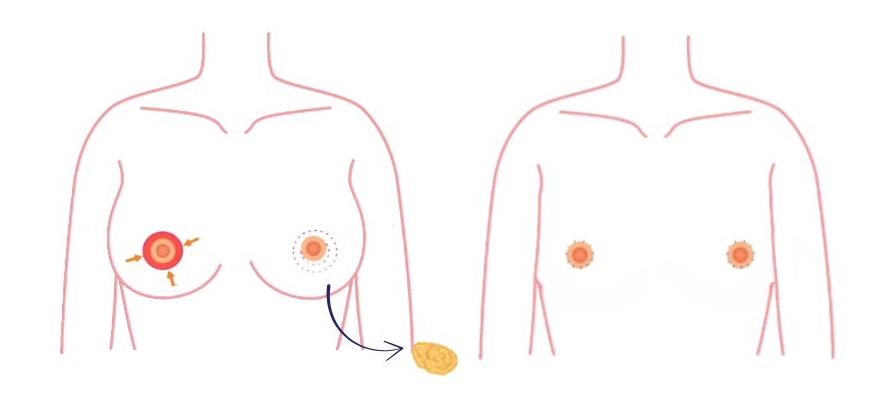 Peri-areolaire techniek: een subtiele borstkasmastectomie met minimale littekens