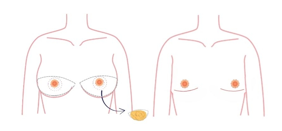 Dubbele incisie: een veel gebruikte mastectomietechniek bij een grotere borstkas met matige tot vollere borsten