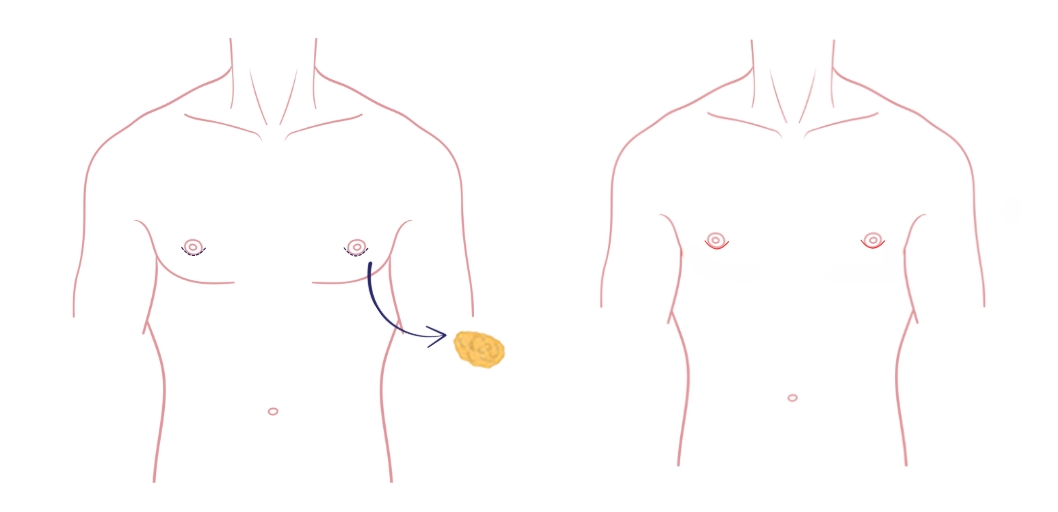 Gynaecomastie operatie - een subtiele ingreep voor kleine borsten