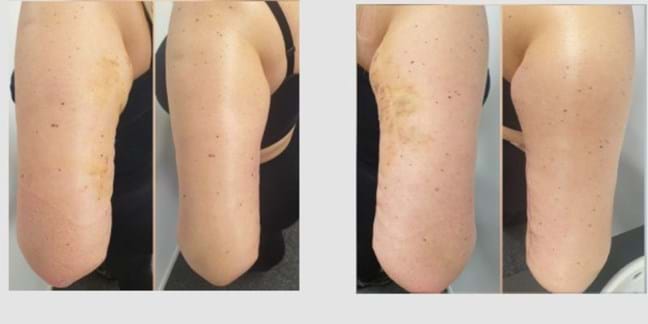 Massages post-liposuccion