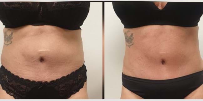 Drainage lymphatique brésilien