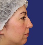 before rhinoplasty showing nasal asymmetry