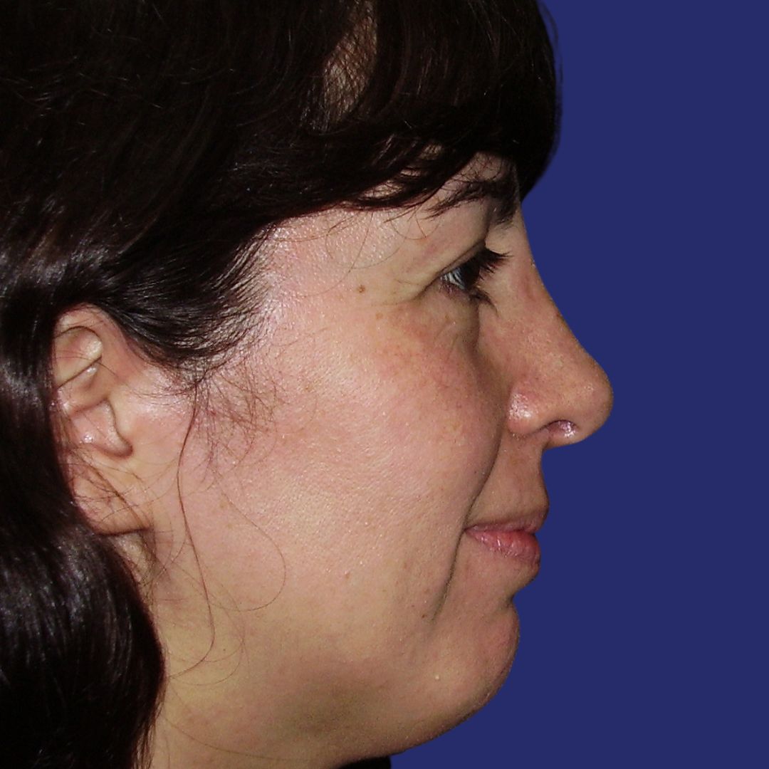 Neussymmetrie en gezichtsbalans na professionele neuscorrectie