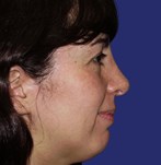 Nasal symmetry and improved facial harmony after rhinoplasty