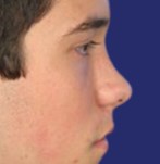 Image before rhinoplasty showing wide nose and septum deviation
