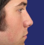 Proportionate nose and improved breathing after rhinoplasty