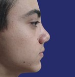 Proportionate nose and improved breathing after rhinoplasty