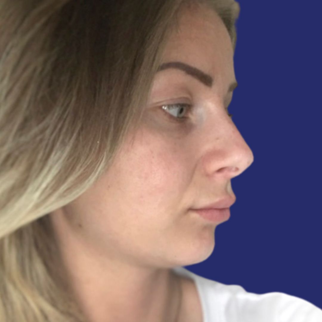 Verfijnde, natuurlijk ogende neus na esthetische neuscorrectie