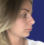 Face before cosmetic nose surgery in Genk