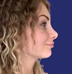 Natural and refined result after rhinoplasty