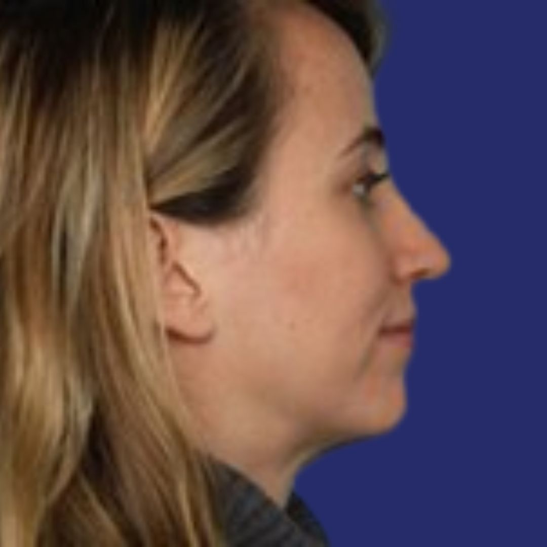 Verfijnde neus en evenwichtig profiel na neuscorrectie in Genk