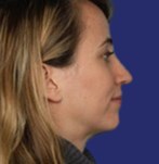 Refined nose and balanced facial profile after rhinoplasty