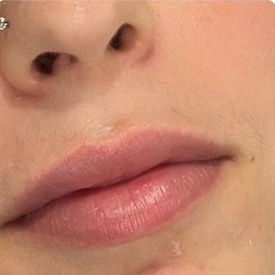 Voorafbeelding van de lippen vóór de lipfillerbehandeling, met natuurlijk volume.